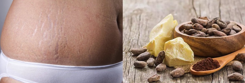 Can you use Cocoa Butter For Scars?