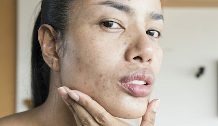 How Can You Tell If Tretinoin Has Expired Or Gone Bad