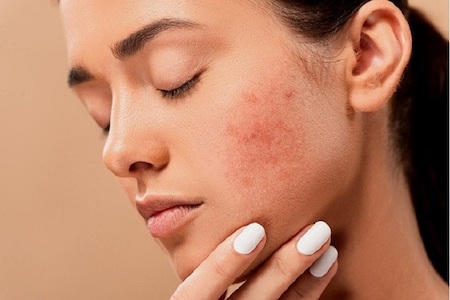 Negative effects of tretinoin