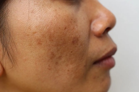 Negative effects when you stop using tretinoin