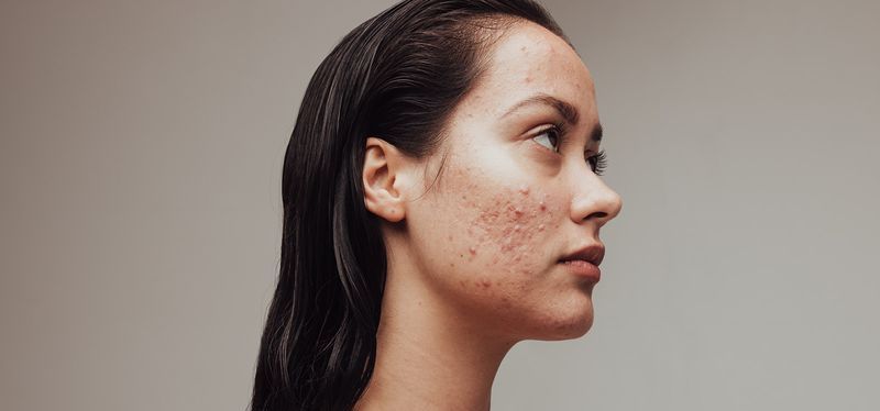 What Happens If You Stop Using Tretinoin Cream (Retin-A)