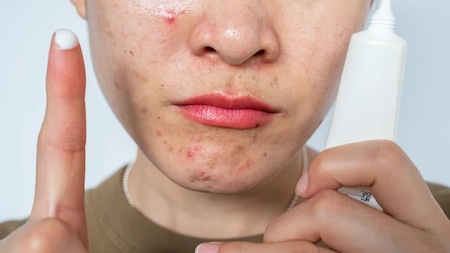 What Happens If You Stop Using Tretinoin For Acne