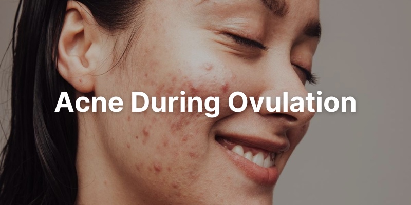Acne When Ovulating