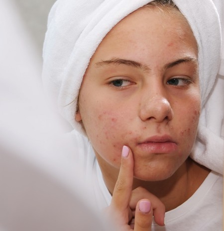 Is Acne Worse During Ovulation