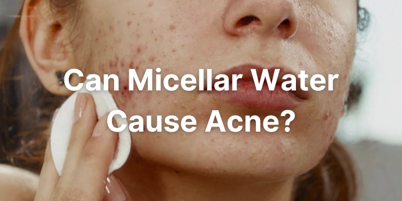 Can Micellar Water Cause Acne