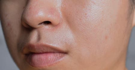 Should Oily Skin Use Glycerin
