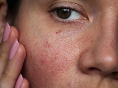What To Do If Toner Burns Your Face
