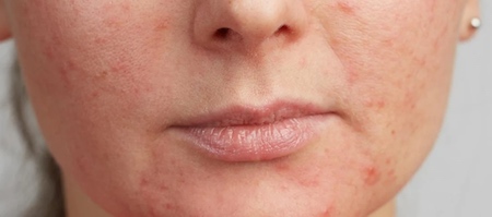 glycolic acid before or after retinol