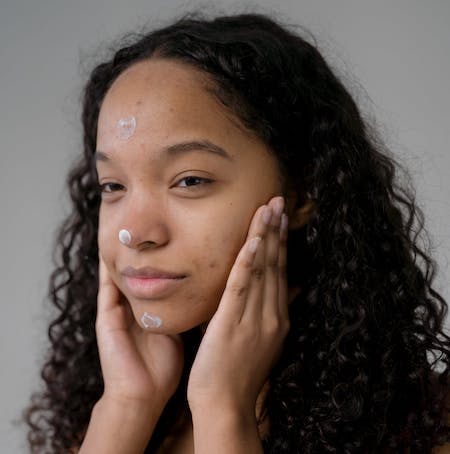 Should I use moisturiser if I have acne?